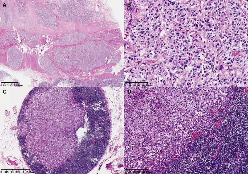 【佳学基因检测】原发性结肠副神经节瘤伴淋巴结转移基因检测辅助治疗